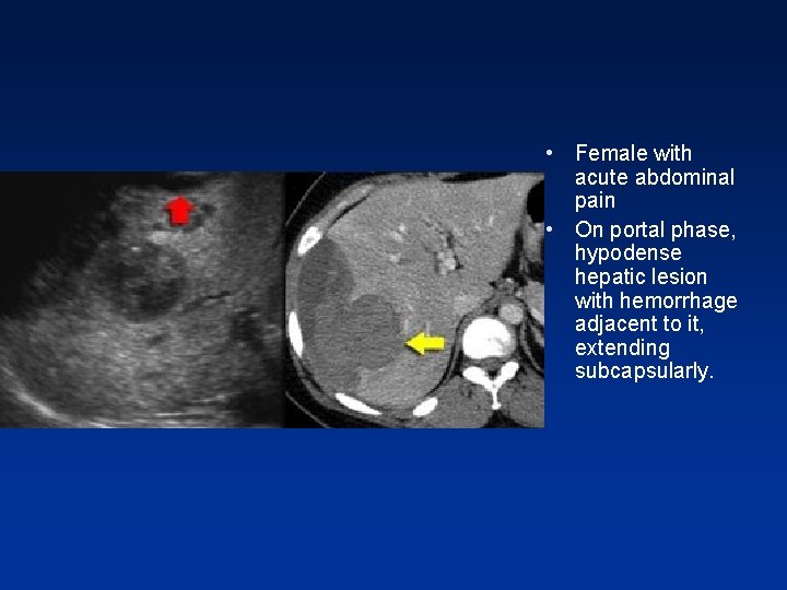 • Female with acute abdominal pain • On portal phase, hypodense hepatic lesion • Female with acute abdominal pain • On portal phase, hypodense hepatic lesion