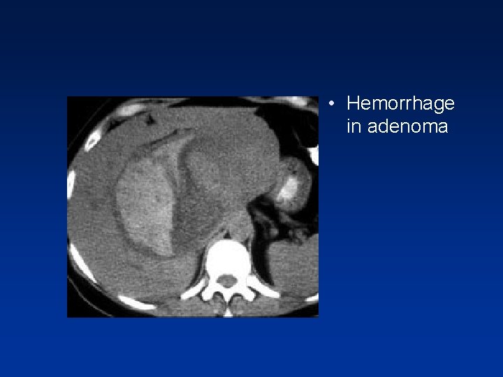 • Hemorrhage in adenoma • Hemorrhage in adenoma