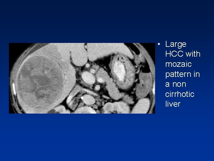 • Large HCC with mozaic pattern in a non cirrhotic liver • Large HCC with mozaic pattern in a non cirrhotic liver