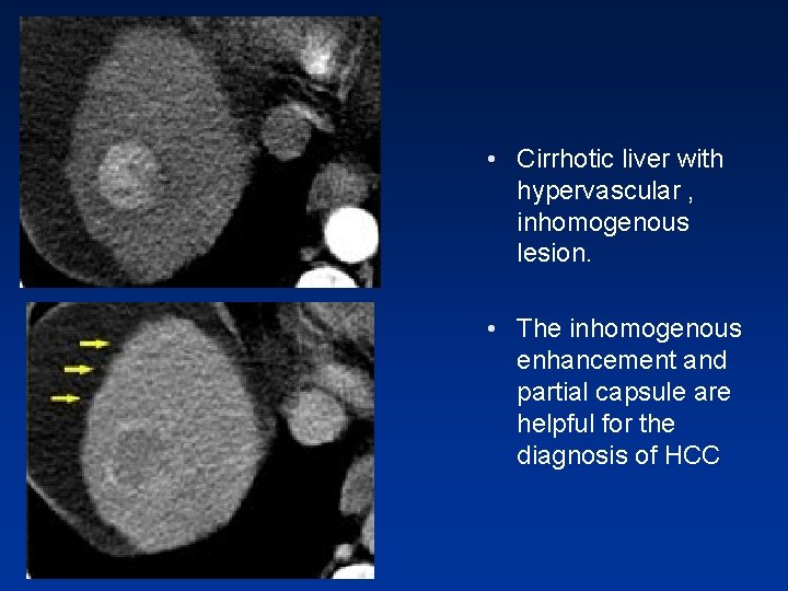 • Cirrhotic liver with hypervascular , inhomogenous lesion. • The inhomogenous enhancement and • Cirrhotic liver with hypervascular , inhomogenous lesion. • The inhomogenous enhancement and
