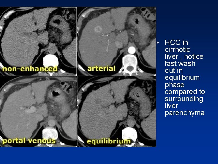 • HCC in cirrhotic liver , notice fast wash out in equilibrium phase • HCC in cirrhotic liver , notice fast wash out in equilibrium phase