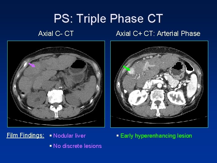 PS: Triple Phase CT Axial C- CT Film Findings: § Nodular liver § No PS: Triple Phase CT Axial C- CT Film Findings: § Nodular liver § No