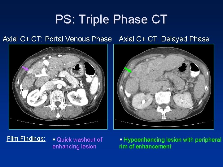 PS: Triple Phase CT Axial C+ CT: Portal Venous Phase Film Findings: § Quick PS: Triple Phase CT Axial C+ CT: Portal Venous Phase Film Findings: § Quick