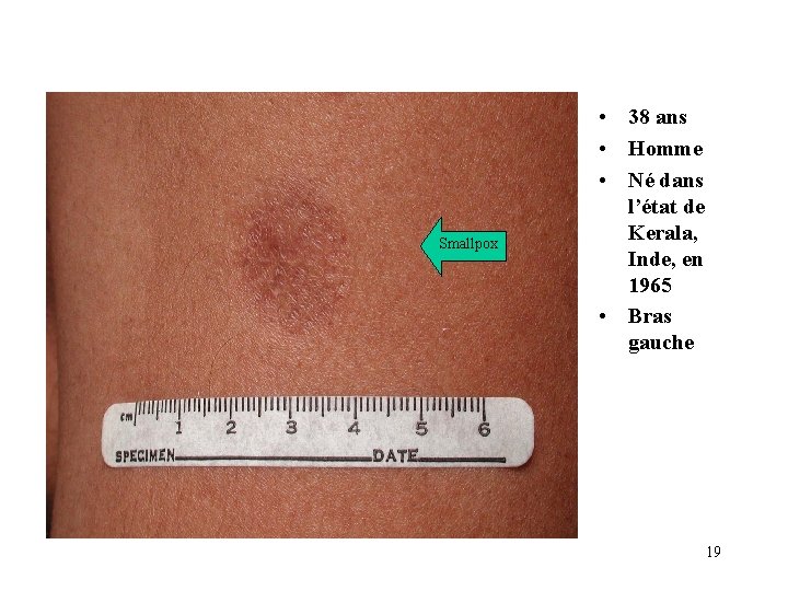 Smallpox • 38 ans • Homme • Né dans l’état de Kerala, Inde, en