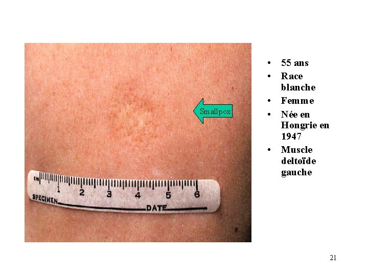Smallpox • 55 ans • Race blanche • Femme • Née en Hongrie en