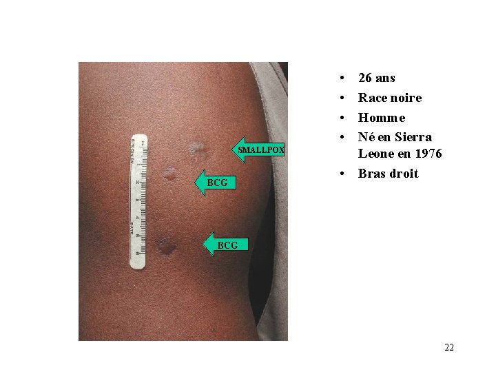 • • SMALLPOX BCG 26 ans Race noire Homme Né en Sierra Leone