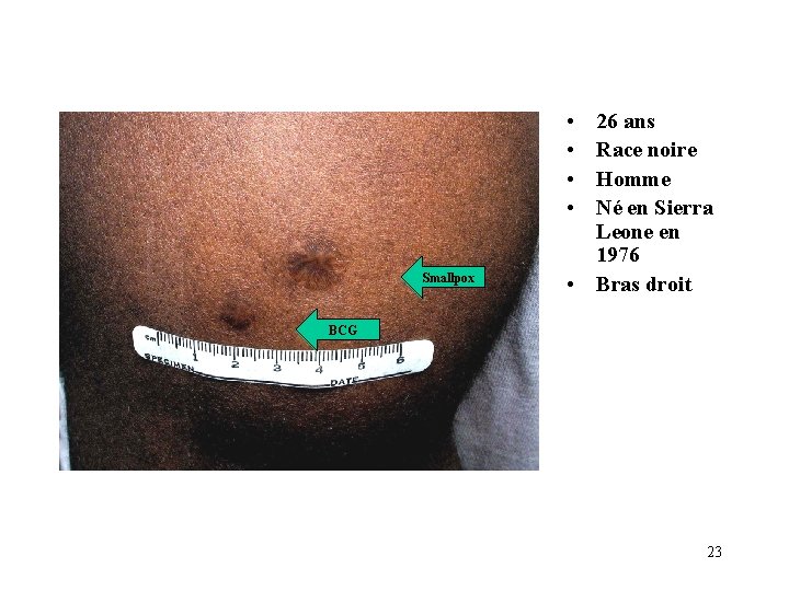  • • Smallpox 26 ans Race noire Homme Né en Sierra Leone en
