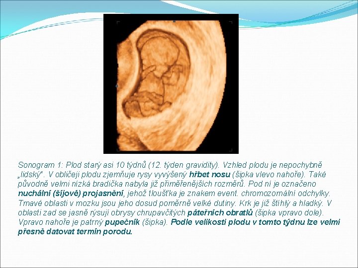 Sonogram 1: Plod starý asi 10 týdnů (12. týden gravidity). Vzhled plodu je nepochybně