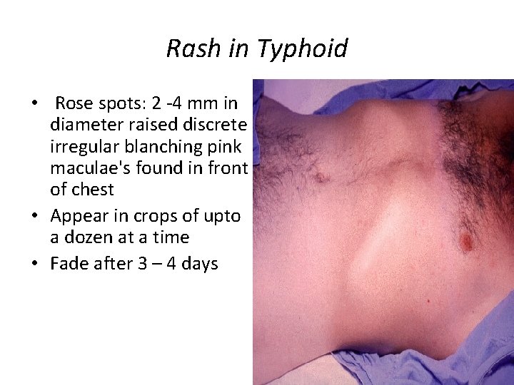 Rash in Typhoid • Rose spots: 2 -4 mm in diameter raised discrete irregular
