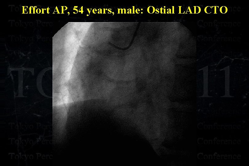 Effort AP, 54 years, male: Ostial LAD CTO 