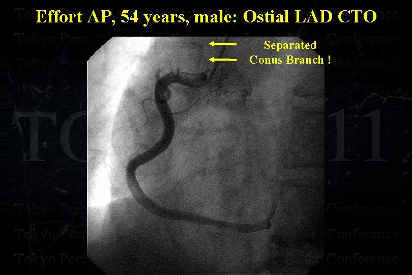 Effort AP, 54 years, male: Ostial LAD CTO Separated Conus Branch ! 