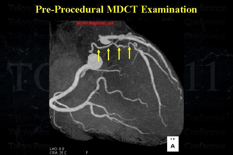 Pre-Procedural MDCT Examination 