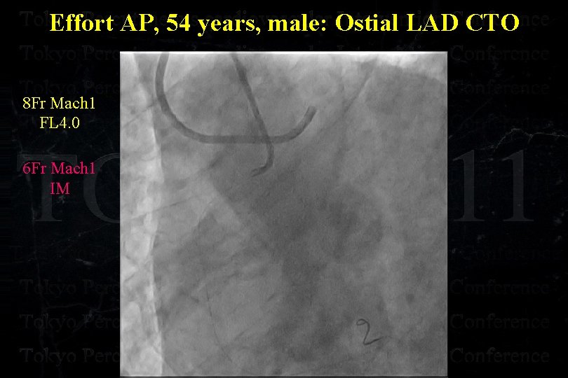 Effort AP, 54 years, male: Ostial LAD CTO 8 Fr Mach 1 FL 4.