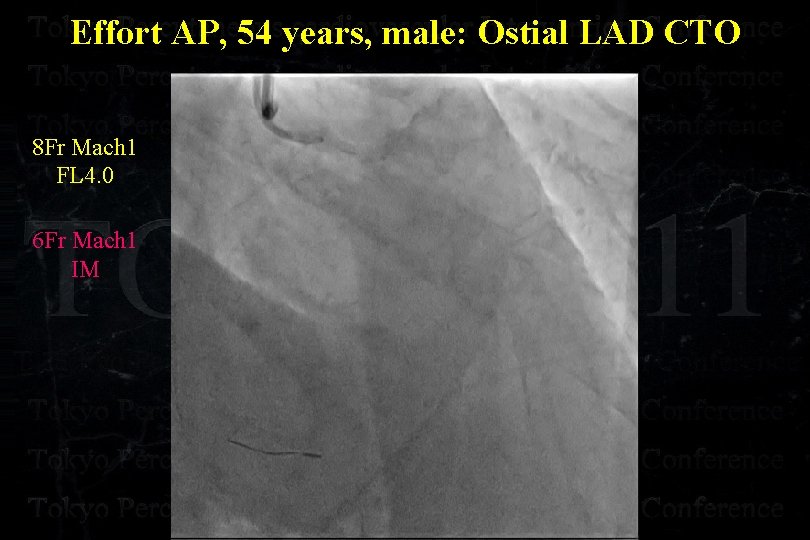 Effort AP, 54 years, male: Ostial LAD CTO 8 Fr Mach 1 FL 4.