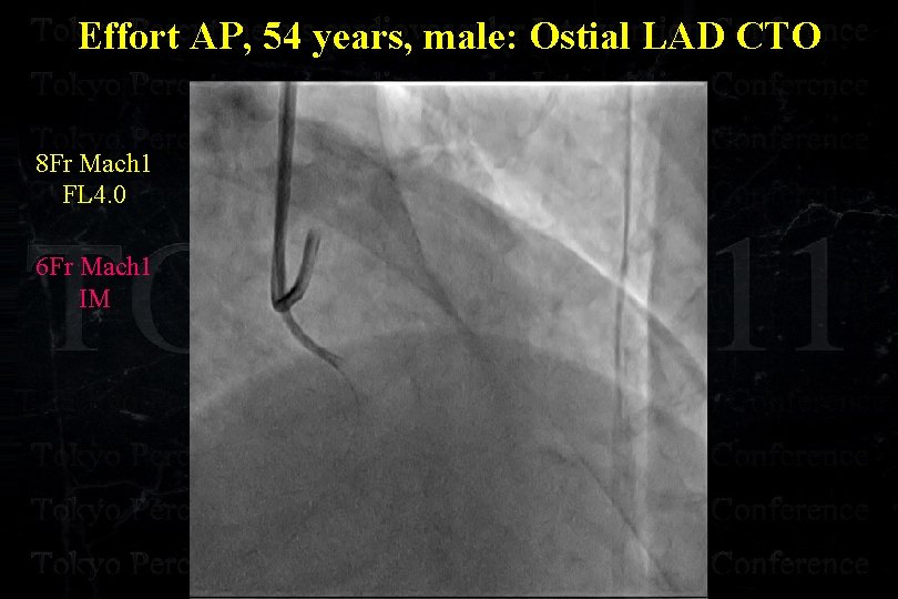 Effort AP, 54 years, male: Ostial LAD CTO 8 Fr Mach 1 FL 4.
