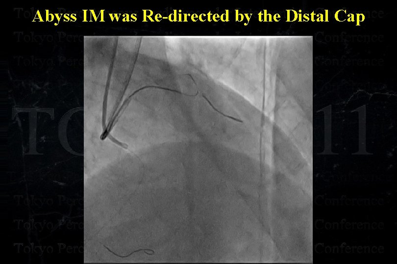 Abyss IM was Re-directed by the Distal Cap 