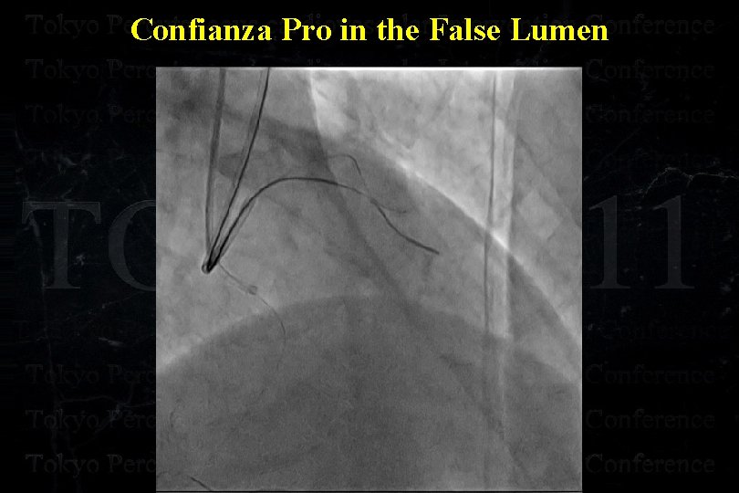 Confianza Pro in the False Lumen 