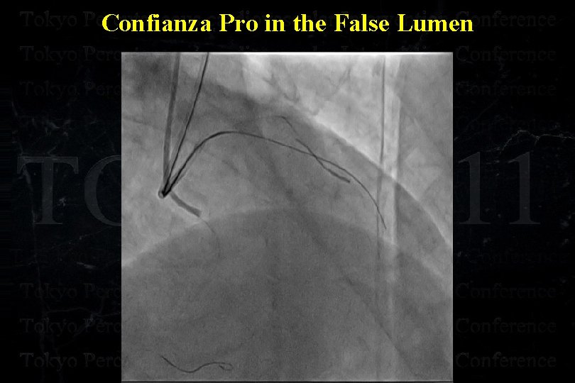 Confianza Pro in the False Lumen 