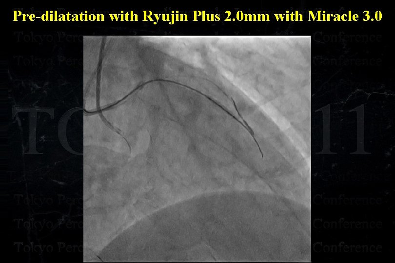 Pre-dilatation with Ryujin Plus 2. 0 mm with Miracle 3. 0 