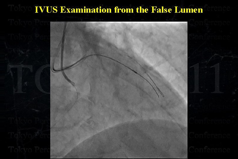 IVUS Examination from the False Lumen 