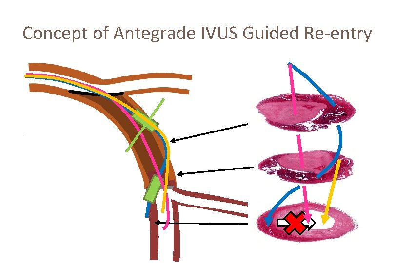 Concept of Antegrade IVUS Guided Re-entry 