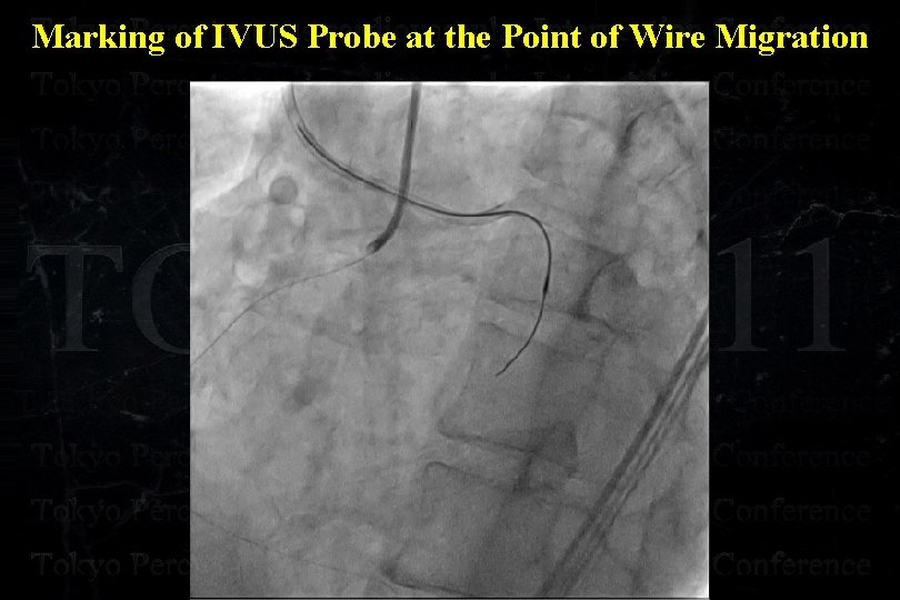 Marking of IVUS Probe at the Point of Wire Migration 