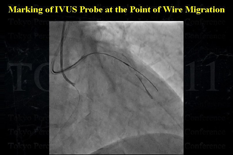 Marking of IVUS Probe at the Point of Wire Migration 