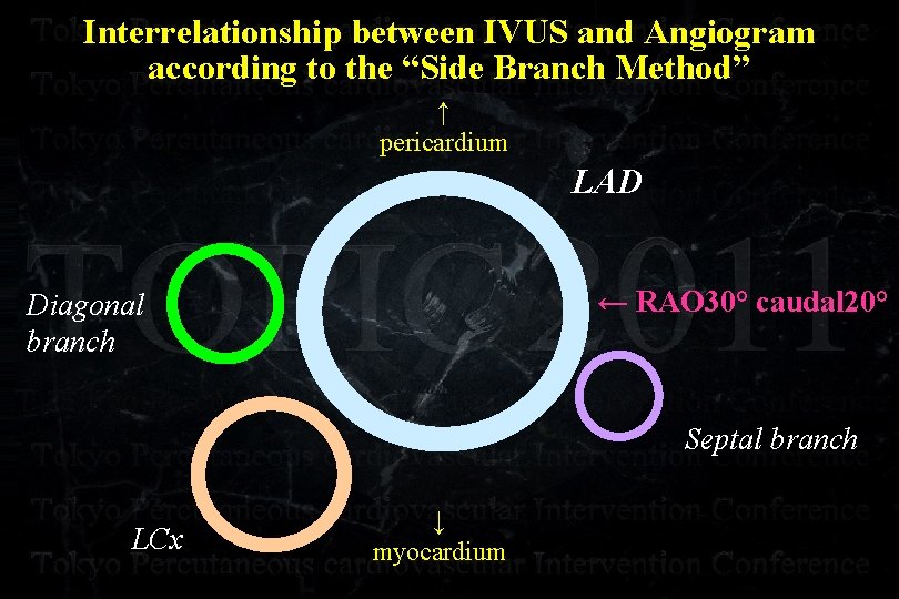 Interrelationship between IVUS and Angiogram according to the “Side Branch Method” ↑ pericardium LAD