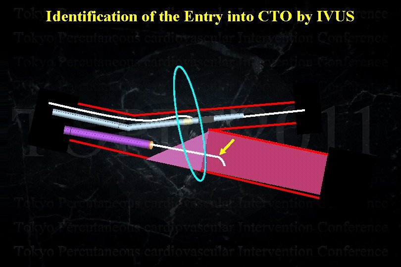 Identification of the Entry into CTO by IVUS 