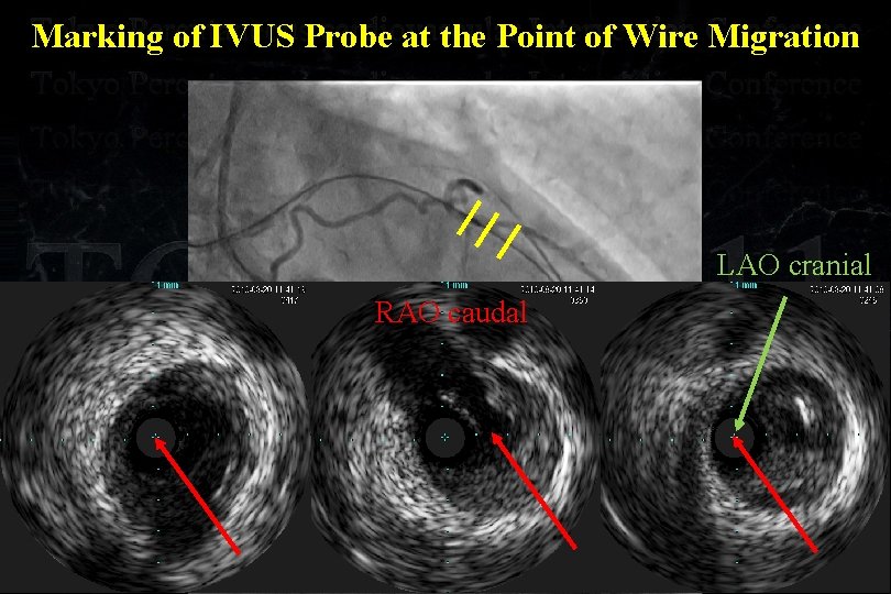 Marking of IVUS Probe at the Point of Wire Migration LAO cranial RAO caudal