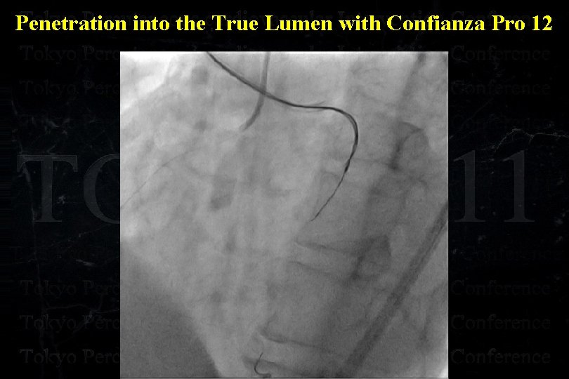 Penetration into the True Lumen with Confianza Pro 12 