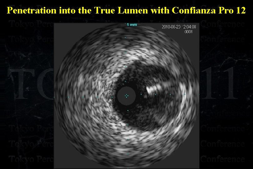 Penetration into the True Lumen with Confianza Pro 12 