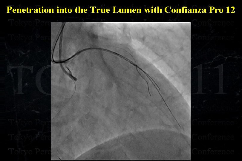 Penetration into the True Lumen with Confianza Pro 12 