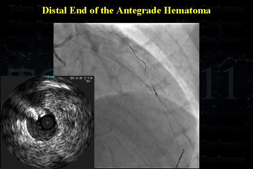 Distal End of the Antegrade Hematoma 