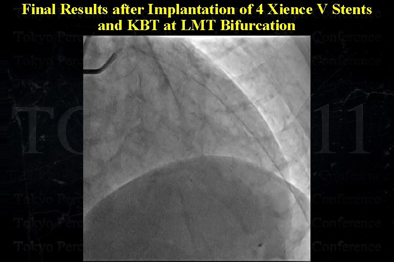 Final Results after Implantation of 4 Xience V Stents and KBT at LMT Bifurcation