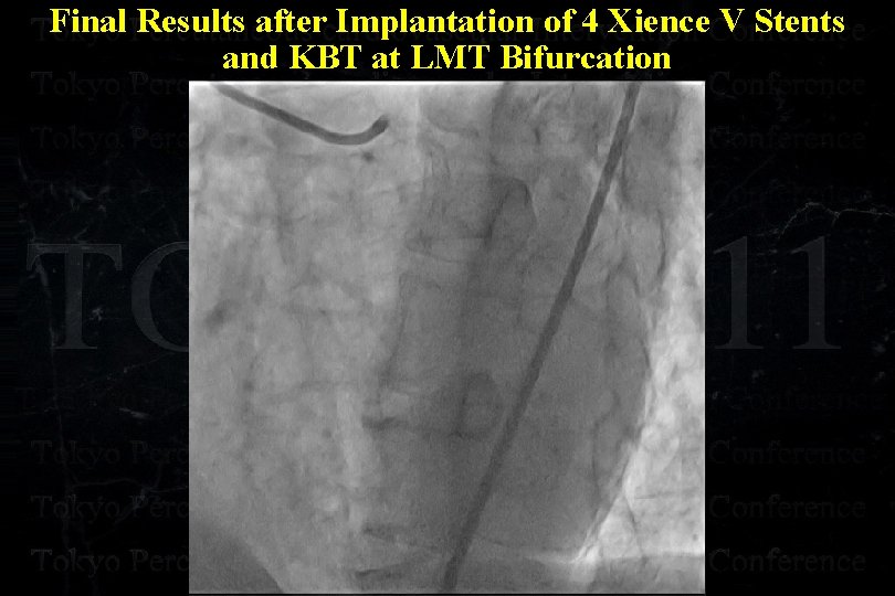 Final Results after Implantation of 4 Xience V Stents and KBT at LMT Bifurcation