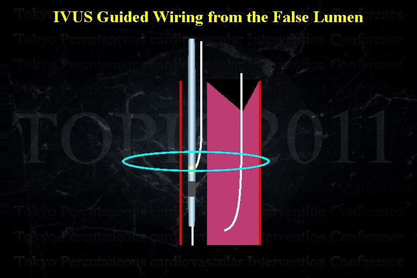 IVUS Guided Wiring from the False Lumen 