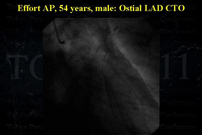 Effort AP, 54 years, male: Ostial LAD CTO 