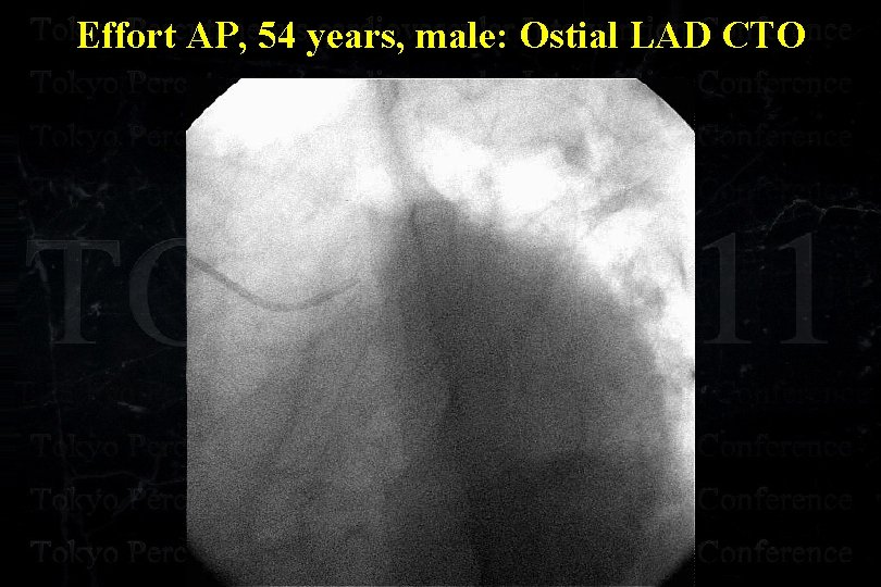 Effort AP, 54 years, male: Ostial LAD CTO 
