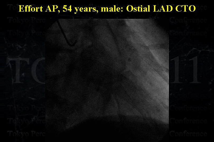 Effort AP, 54 years, male: Ostial LAD CTO 