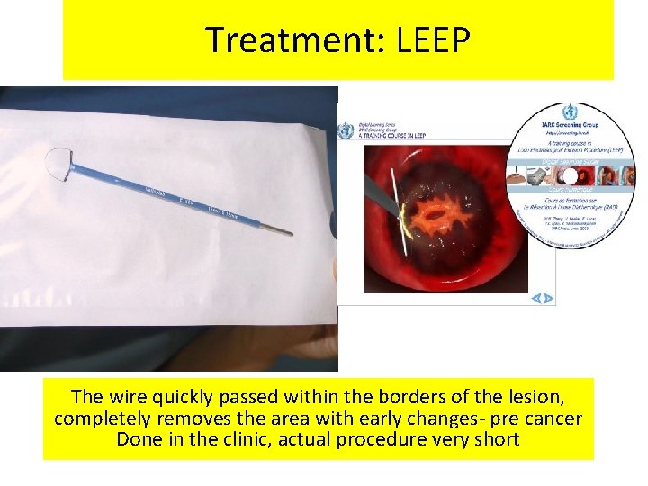 Treatment: LEEP The wire quickly passed within the borders of the lesion, completely removes