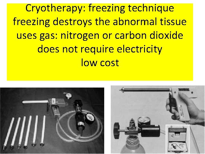 Cryotherapy: freezing technique freezing destroys the abnormal tissue uses gas: nitrogen or carbon dioxide