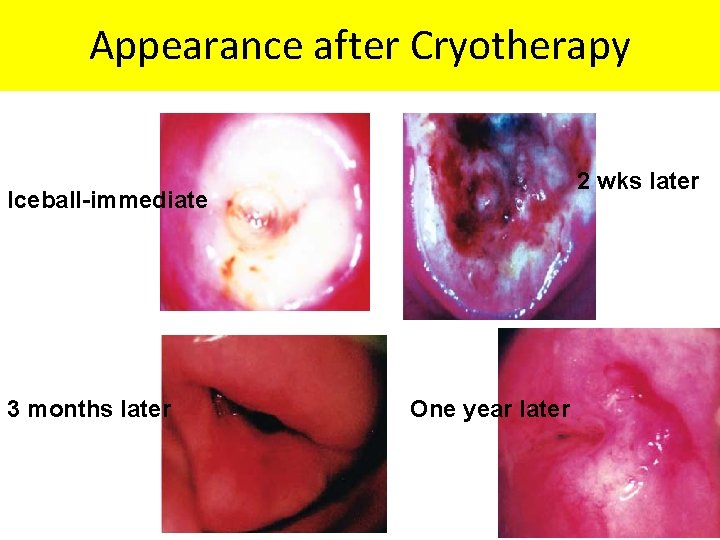 Appearance after Cryotherapy 2 wks later Iceball-immediate 3 months later One year later 