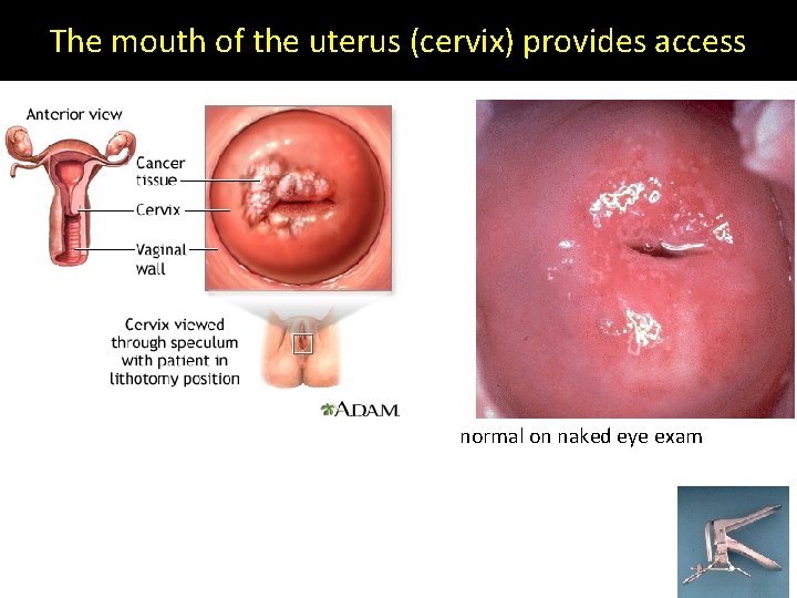 The mouth of the uterus (cervix) provides access normal on naked eye exam 