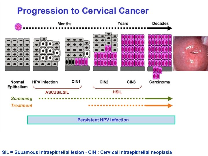 SIL = Squamous intraepithelial lesion - CIN : Cervical intraepithelial neoplasia 