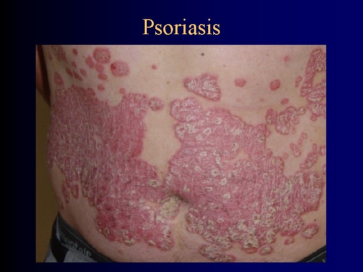 Psoriasis 