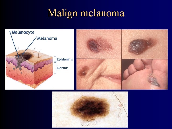 Malign melanoma 