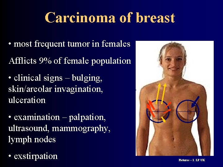 Carcinoma of breast • most frequent tumor in females Afflicts 9% of female population