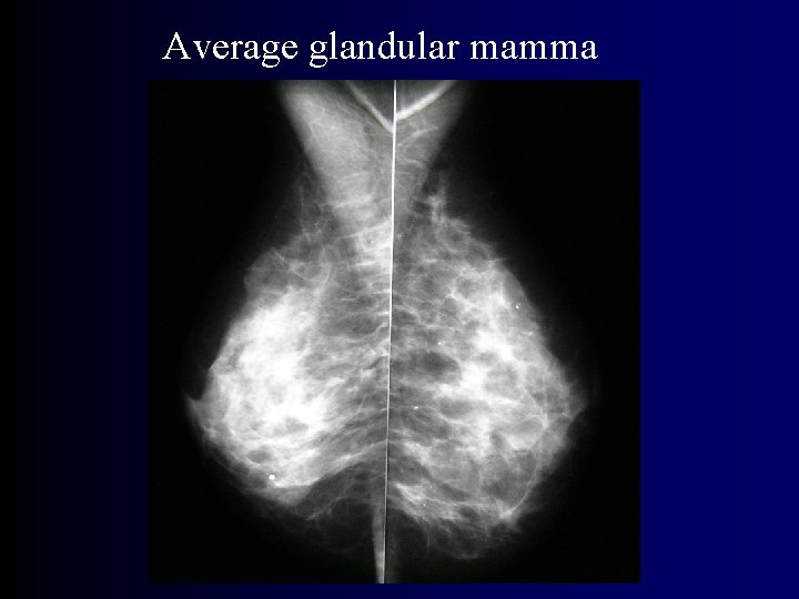 Average glandular mamma 