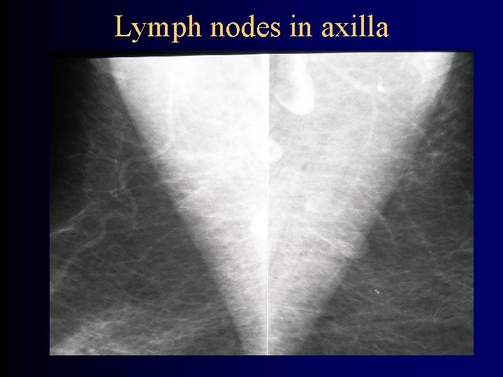 Lymph nodes in axilla 